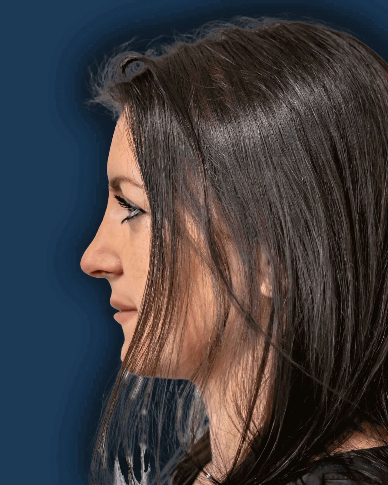 Rinoplastia ultrasónica caso 4 - perfil después de la cirugía