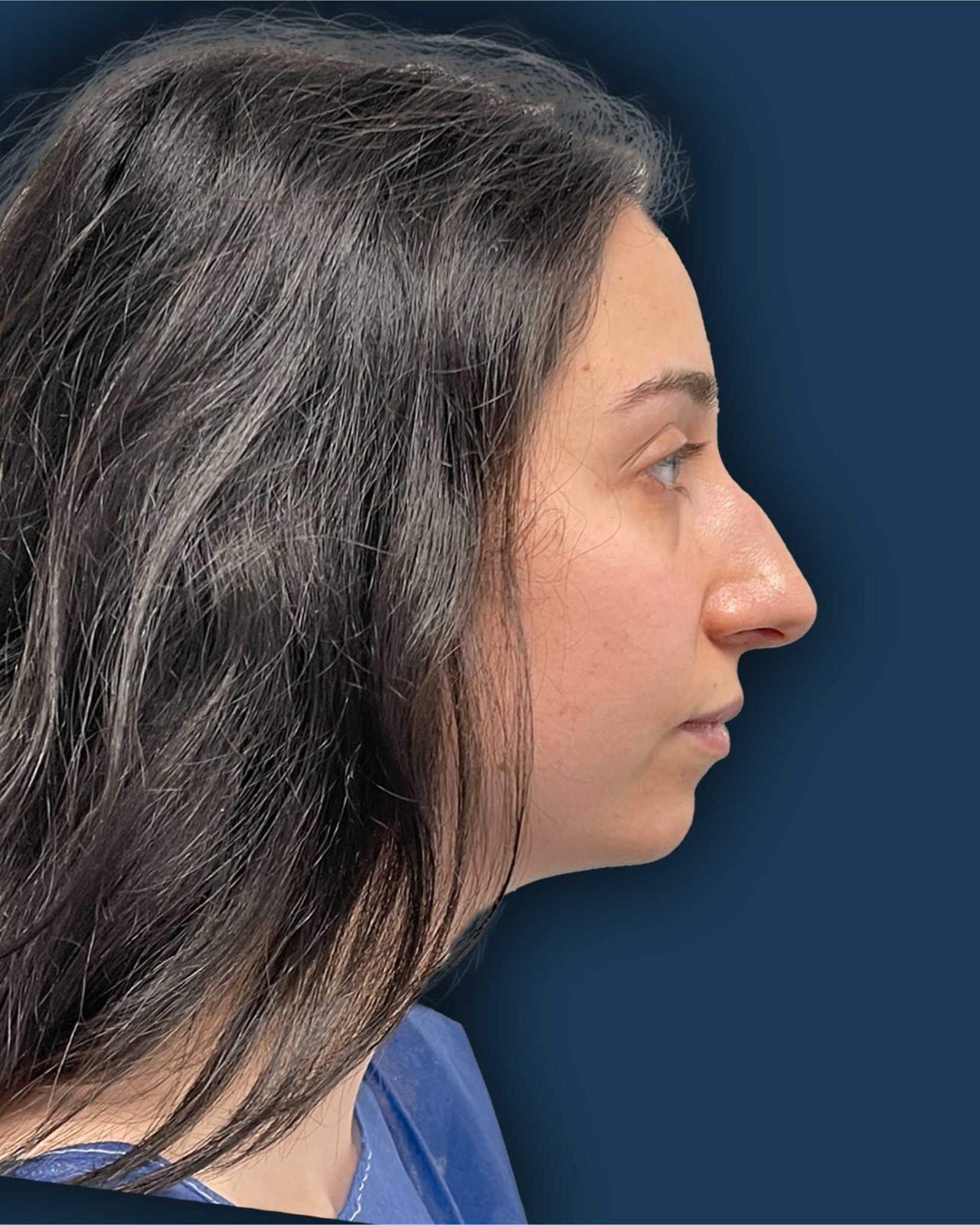 Rinoplastia ultrasónica caso 2 - perfil antes de la cirugía