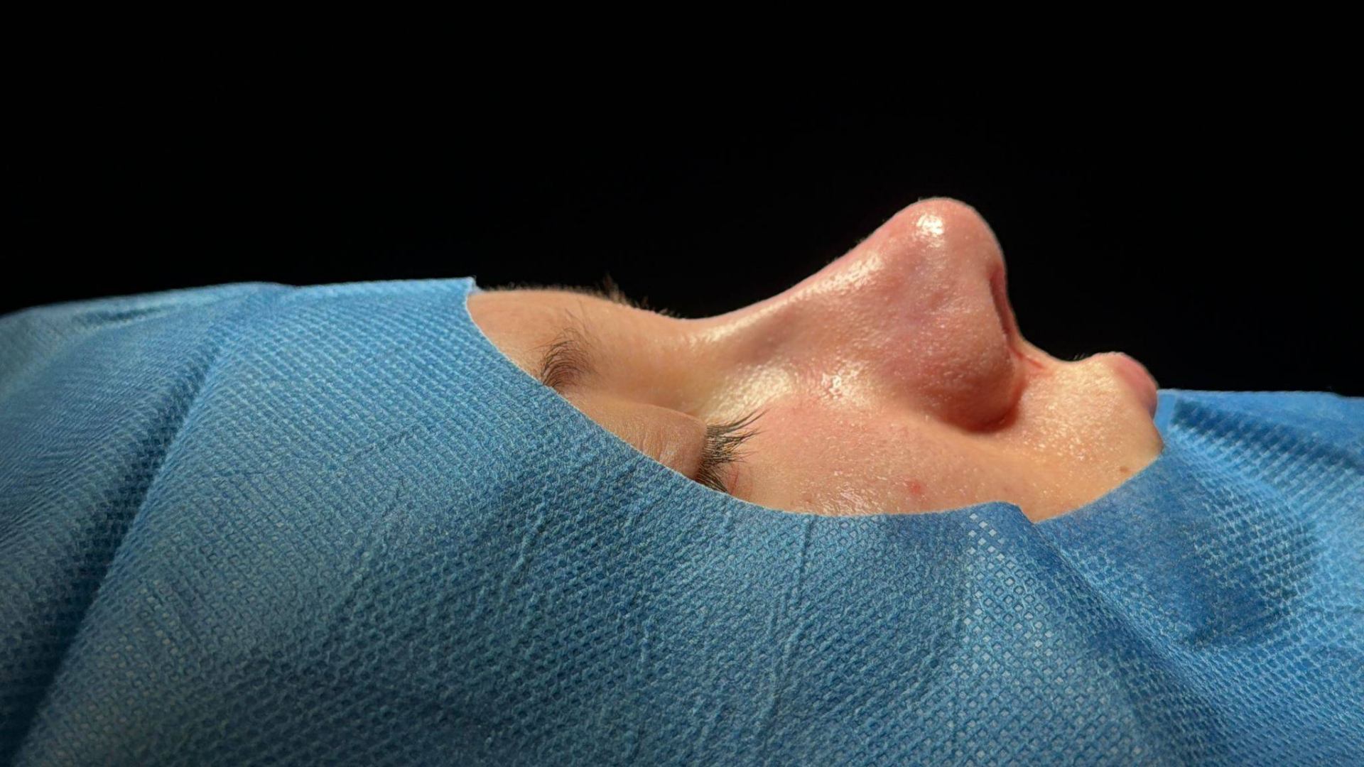 Rinoplastia ultrasónica caso 7 - vista inferior después de la cirugía