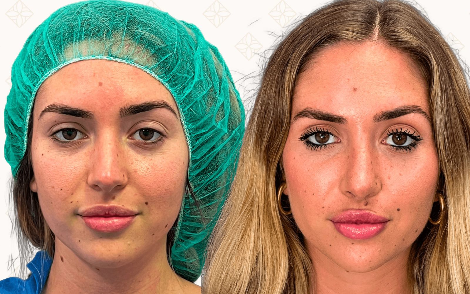 Rinoplastia ultrasónica caso 1 - vista frontal antes y después