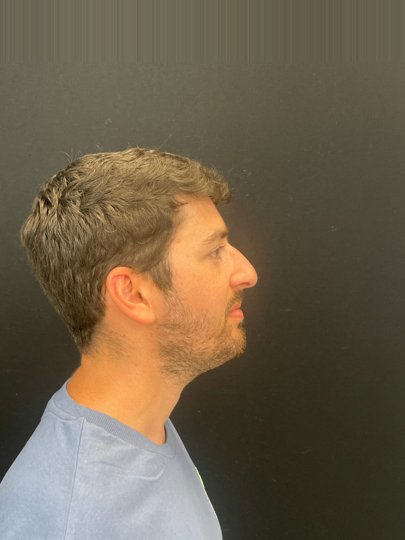 Rinoplastia ultrasónica caso 8 - perfil antes de la cirugía