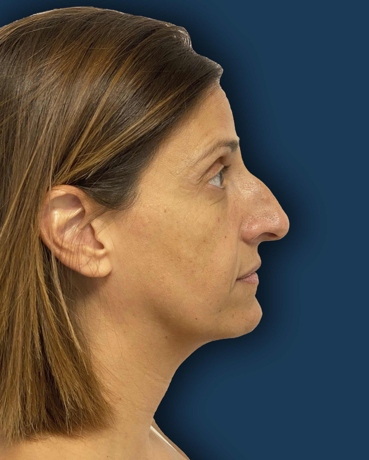 Rinoplastia ultrasónica caso 5 - perfil antes de la cirugía