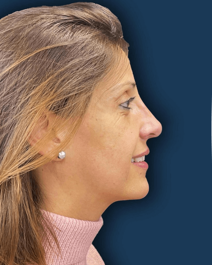 Rinoplastia ultrasónica caso 5 - perfil después de la cirugía