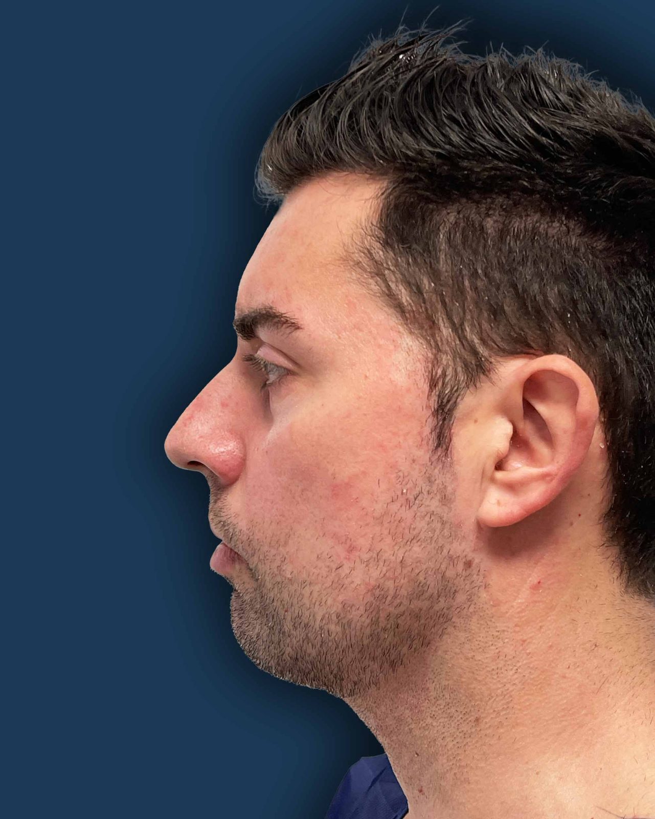 Rinoplastia masculina caso 3 - perfil antes de la cirugía