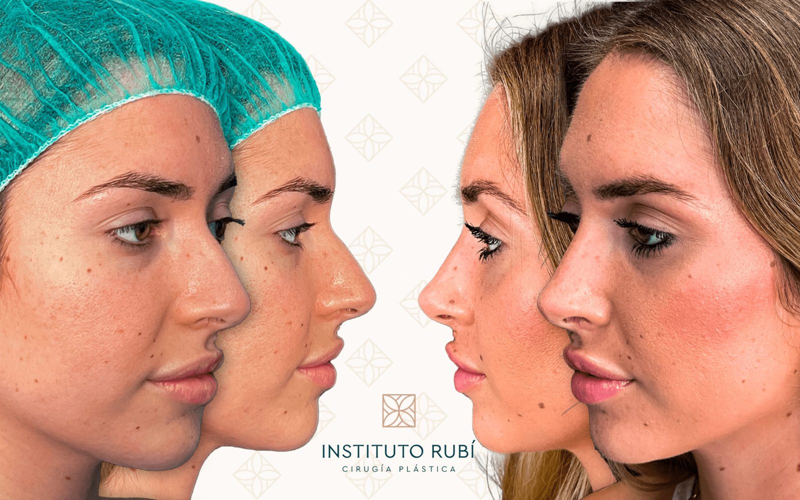 Rinoplastia ultrasónica caso 1 - vista de perfil antes y después