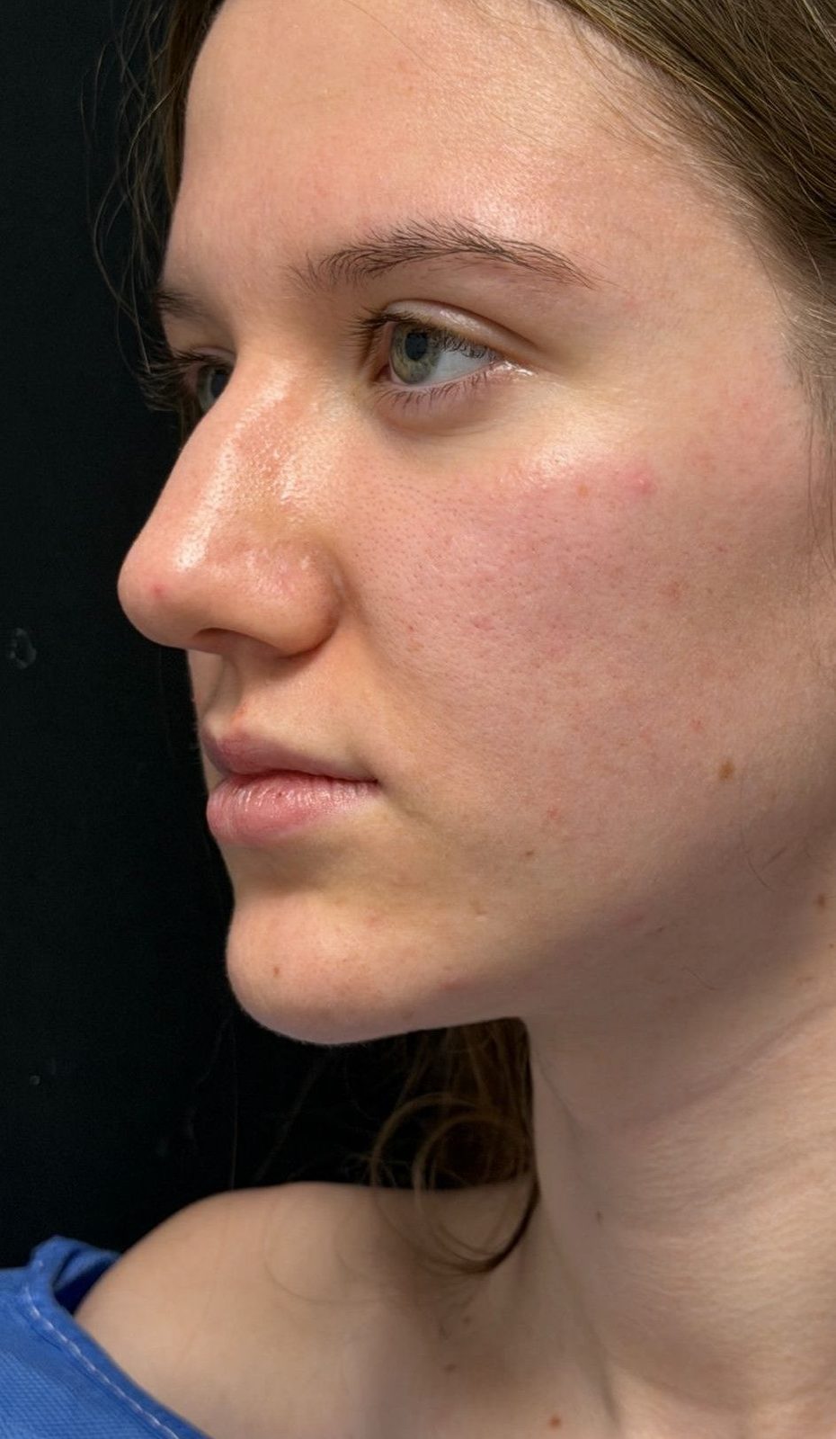 Rinoplastia ultrasónica caso 6 - perfil antes de la cirugía