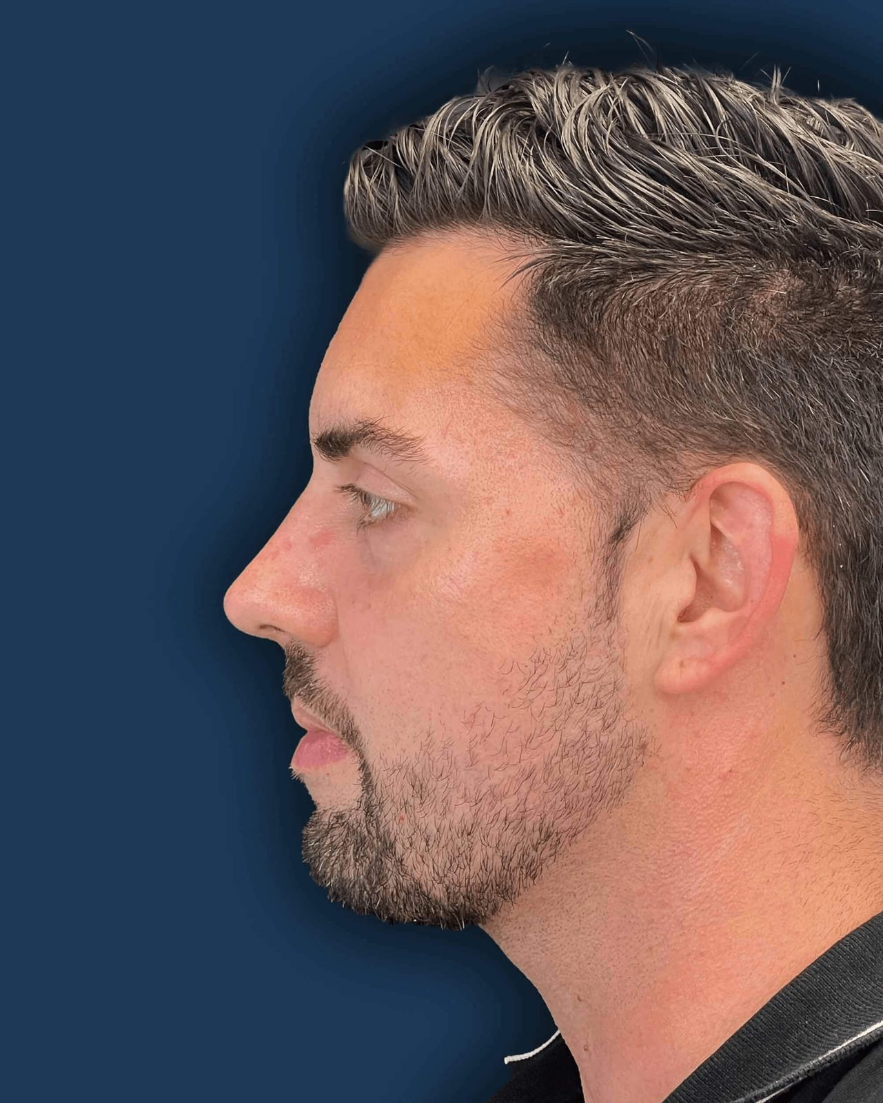 Rinoplastia masculina caso 3 - perfil después de la cirugía