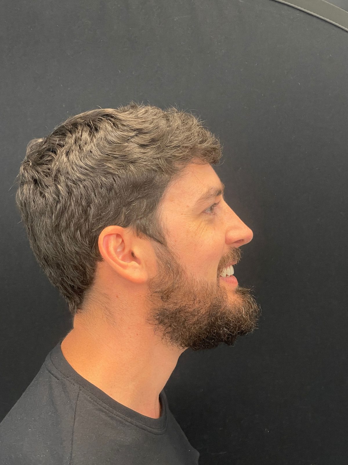 Rinoplastia ultrasónica caso 8 - perfil después de la cirugía