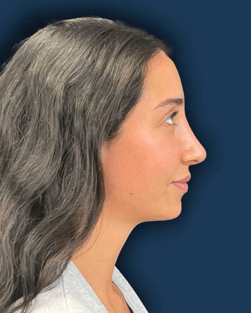 Rinoplastia ultrasónica caso 2 - perfil después de la cirugía