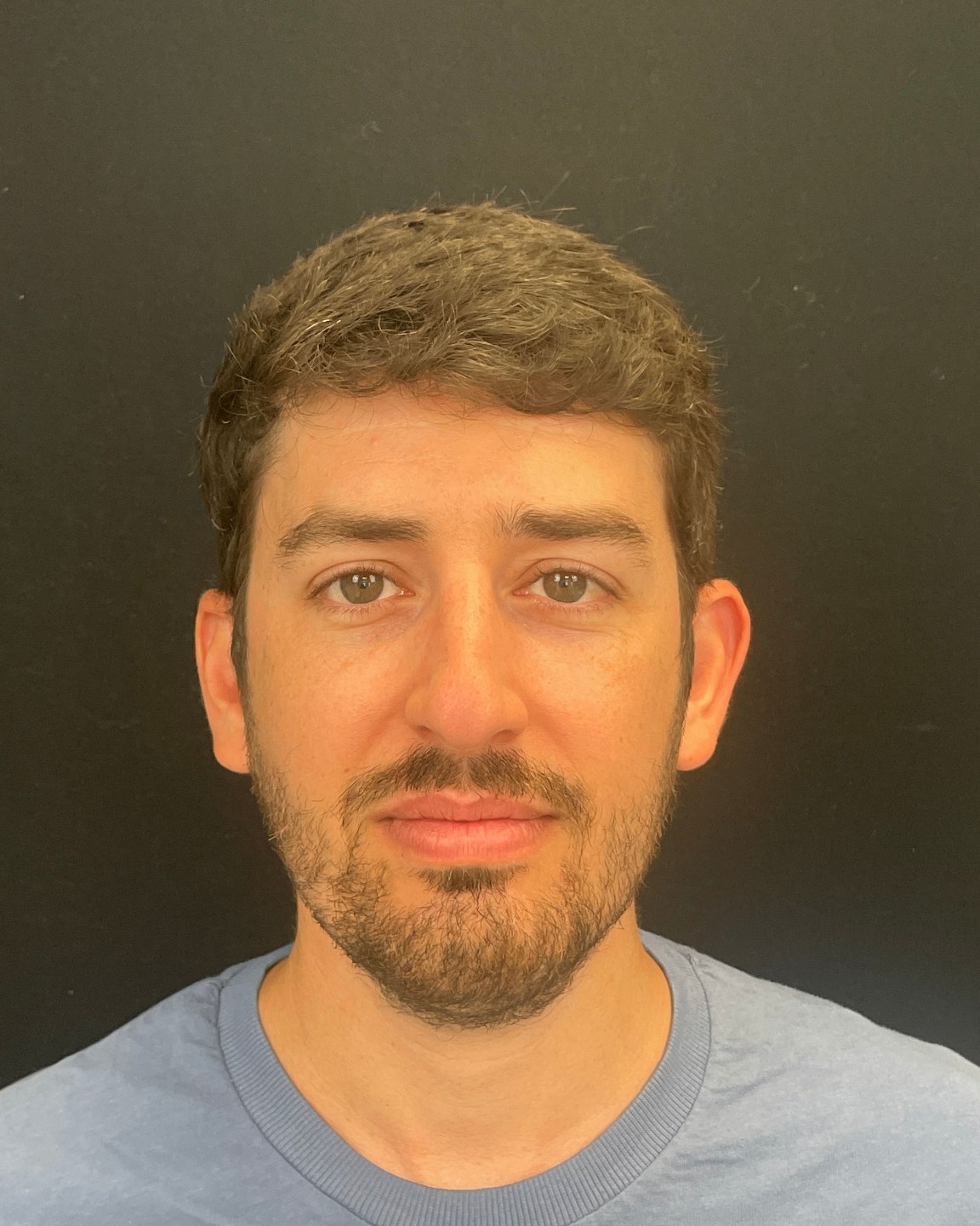 Rinoplastia masculina caso 9 - vista frontal antes de la cirugía