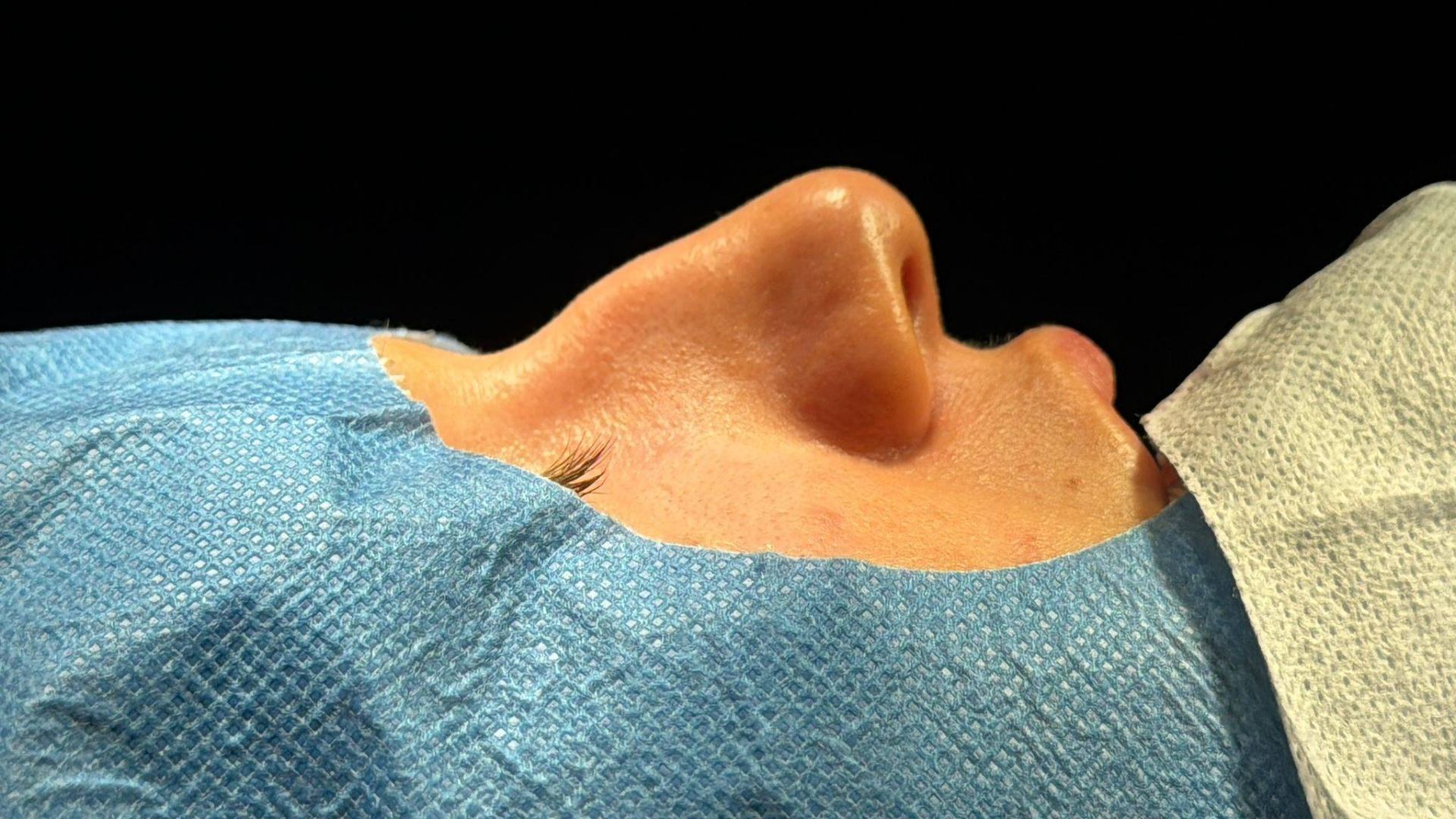 Rinoplastia ultrasónica caso 7 - vista inferior antes de la cirugía