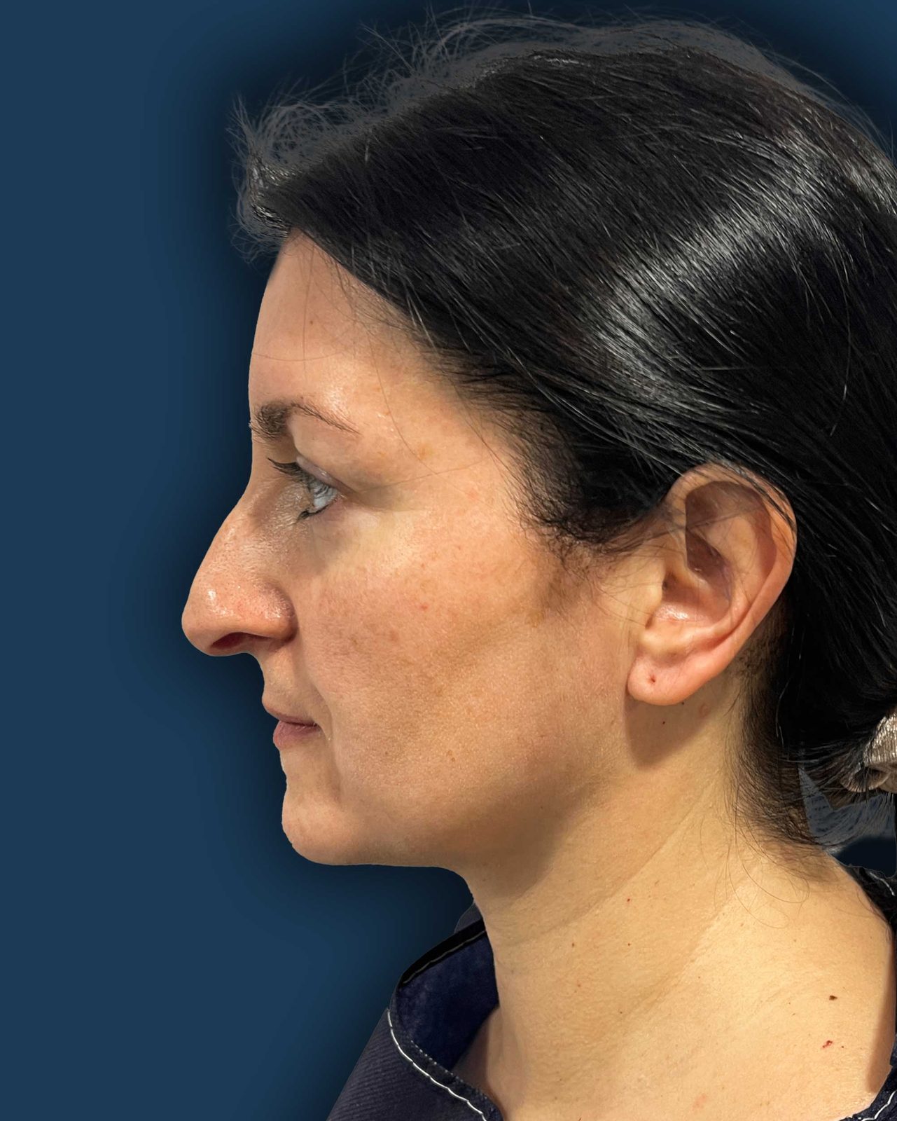 Rinoplastia ultrasónica caso 4 - perfil antes de la cirugía
