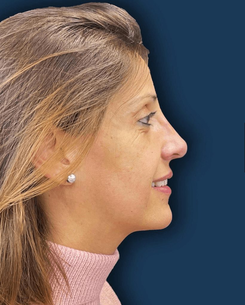 Rinoplastia ultrasónica caso 5 - perfil después de la cirugía