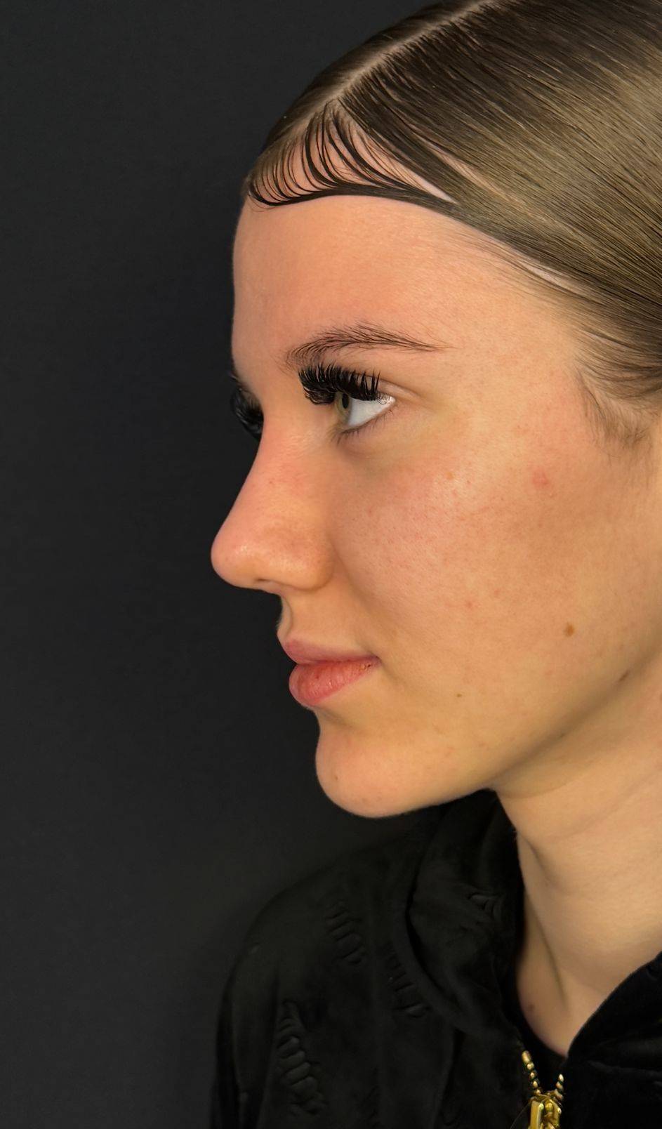 Rinoplastia ultrasónica caso 6 - perfil después de la cirugía